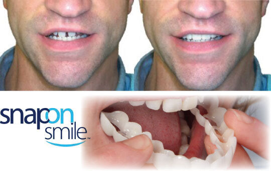 Carillas Dentales Instantáneas – Sonríe Perfecto en Minutos