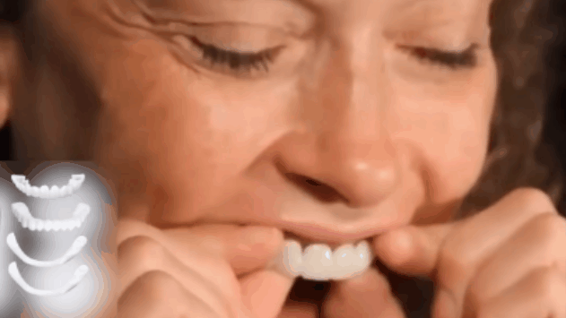 Carillas Dentales Instantáneas – Sonríe Perfecto en Minutos