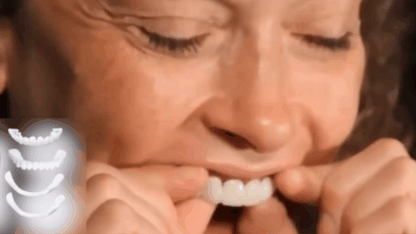Carillas Dentales Instantáneas – Sonríe Perfecto en Minutos